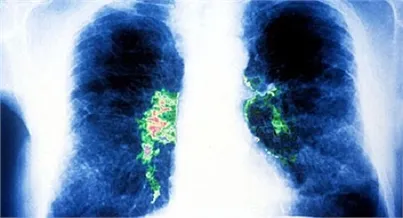 Dịch viêm phổi do Legionella bùng phát ở Canada